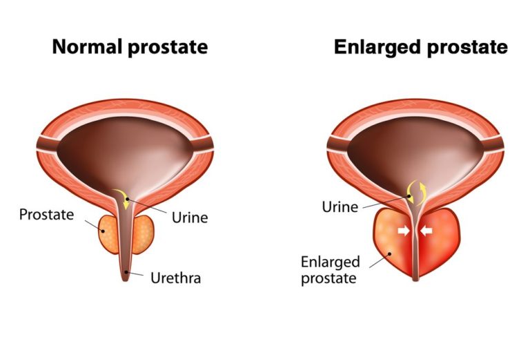 Benign Prostatic Disorder Bradenton Fl Urology Partners