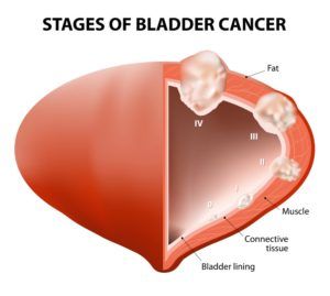 Diagram showing the stages of bladder cancer