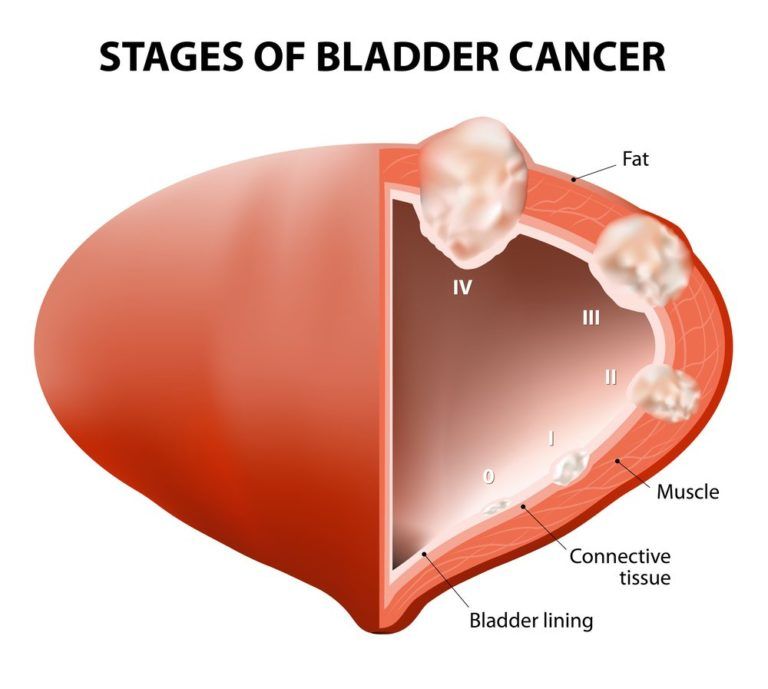 bladder cancer essay