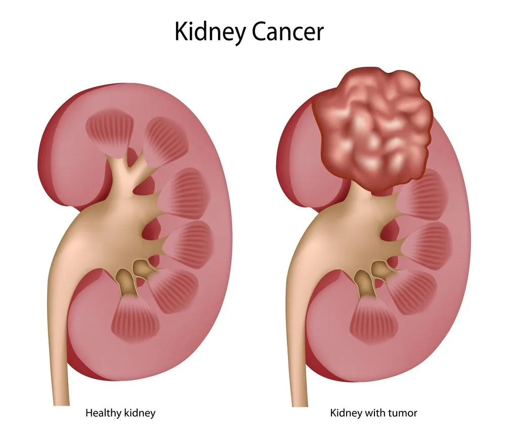 Tipos de cáncer de riñón