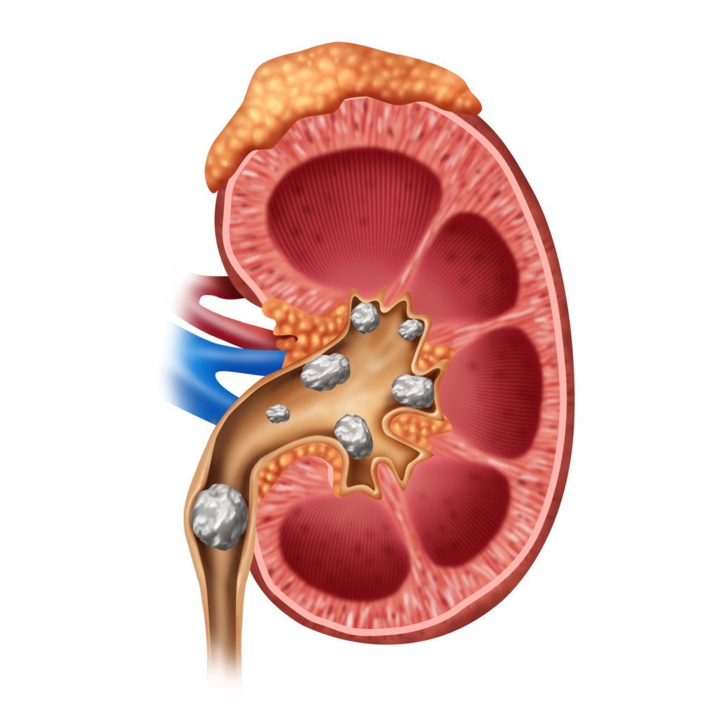 how-big-is-a-4mm-kidney-stone-healthykidneyclub