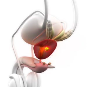 3d Illustration of Cancer Isolated in Prostate