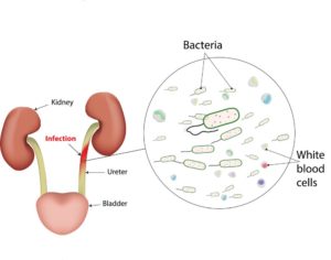 Diagram Illustrating aspects of a urinary tract infection