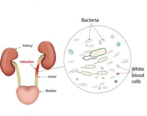 Diagram Illustrating aspects of a urinary tract infection